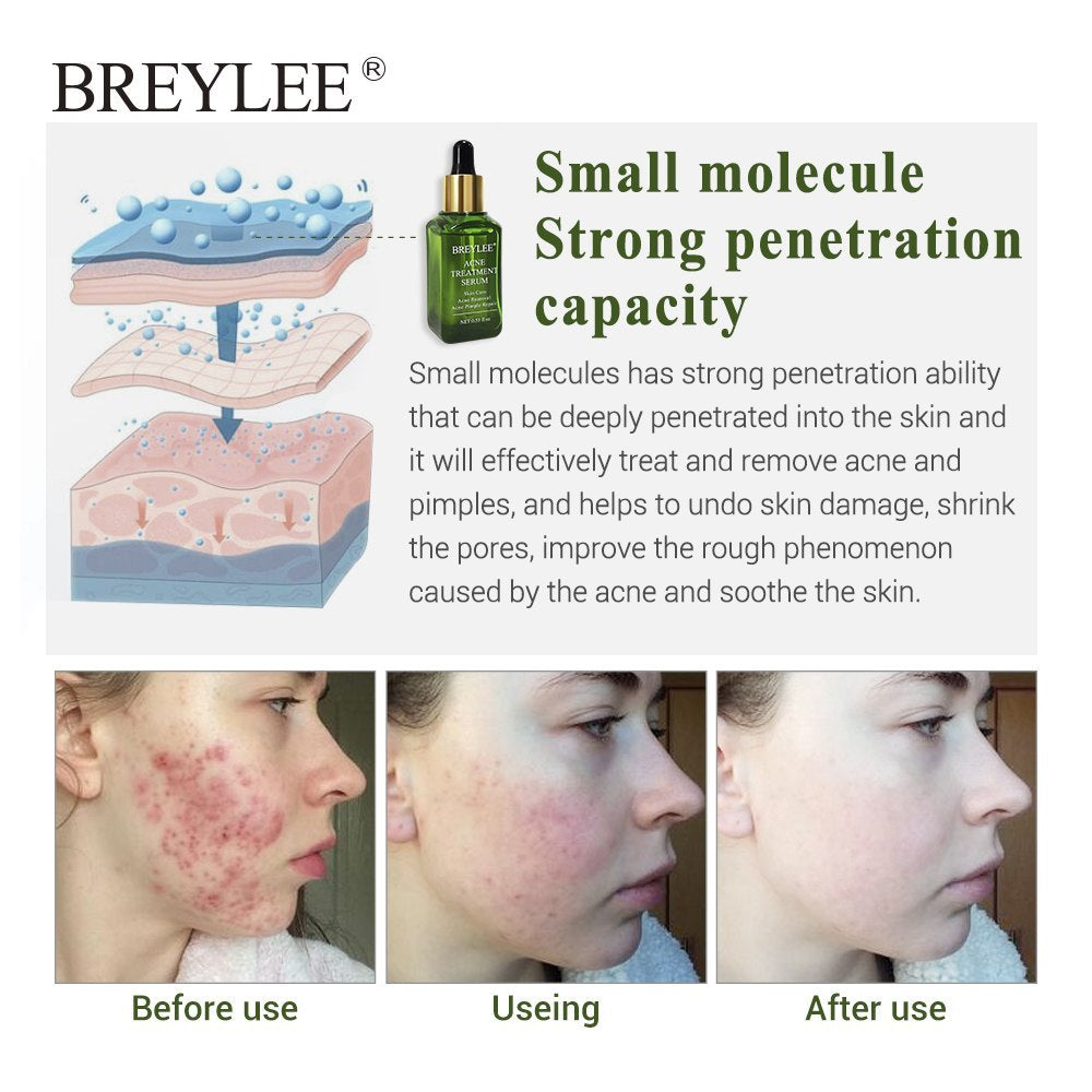 Suero para el tratamiento del acné BREYLEE